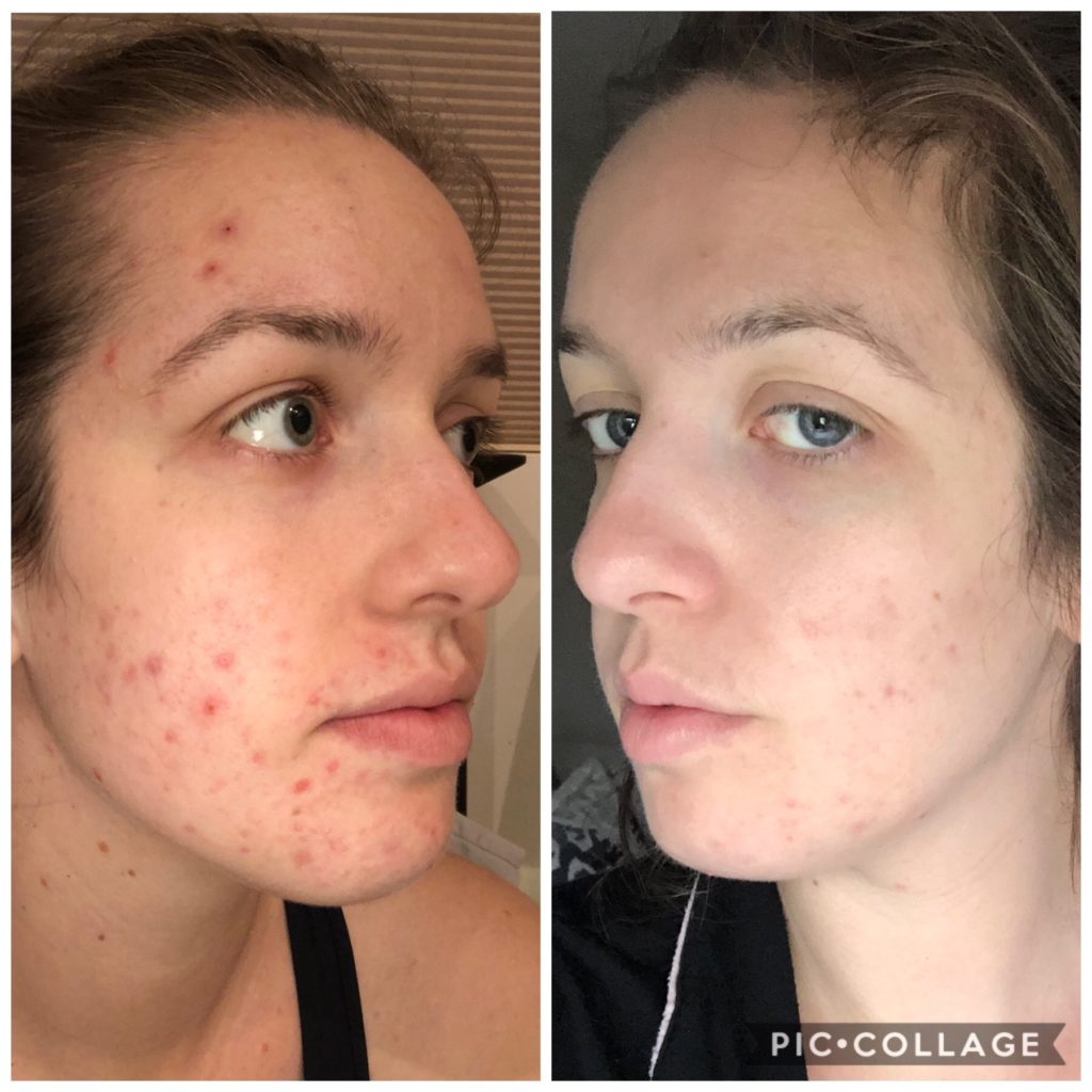 Claire Heals Acne with Autoimmune Paleo