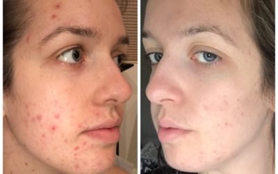 Client Success Story: Claire Said Goodbye to Anxiety, Acne, and Antibodies